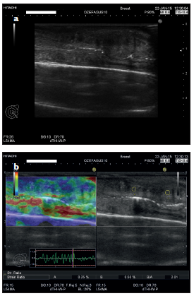 Compressive Sonoelastography Findings of Esophageal Carcinoma