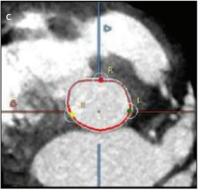 Multidetector Computed Tomography Angiography (MDCT) in the Pre-Procedural Assessment of Patients Undergoing Transcatheter Aortic Valve Replacement