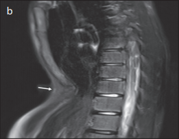 Thoracic Magnetic Resonance Imaging Applications in Children