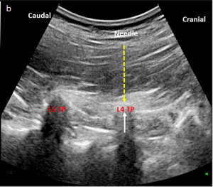 Lumbar Erector Spinae Plane Block as a Main Anesthetic Method for Hip Surgery in High Risk Elderly Patients: Initial Experience with a Magnetic Resonance Imaging