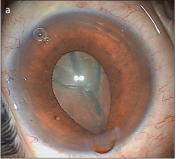 Bilateral Intraoperative Floppy Iris Syndrome Associated with Silodosin Intake