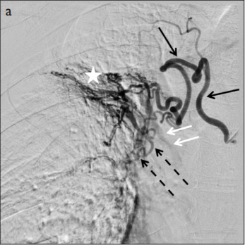 Angiographic Findings and Outcomes of Bronchial Artery Embolization in Patients with Pulmonary Tuberculosis 