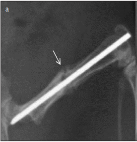 Is Ebselen A Therapeutic Target in Fracture Healing?