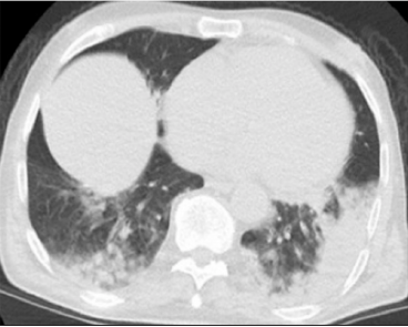 Atypical Presentation of COVID-19: Acute Renal Failure